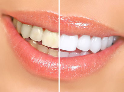 Whiter Teeth